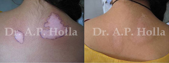 before after white patches on skin care