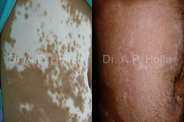 before after white patches on skin care