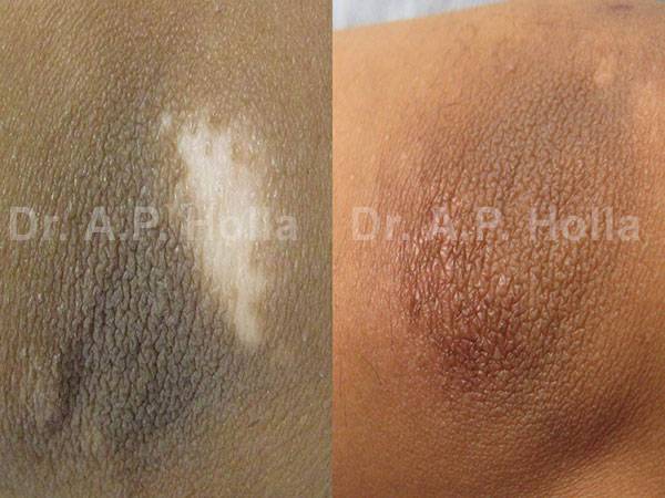 before after skin pigmentation treatment