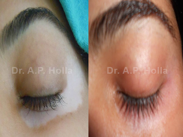 before after white patches treatment