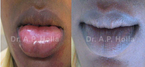 before after white patches on skin