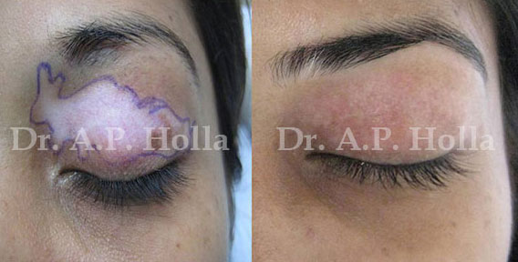 before after treatment for vitiligo on eye