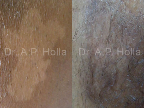 before after skin pigmentation treatment