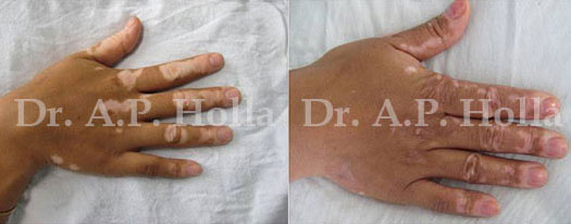 before after white patches skin problem treatment