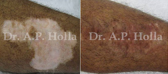 before after white skin patches treatment