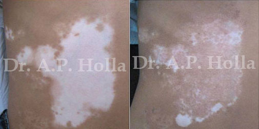 before after vitiligo disease care