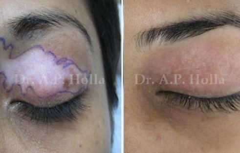 eyelid vitiligo treatment   delhi