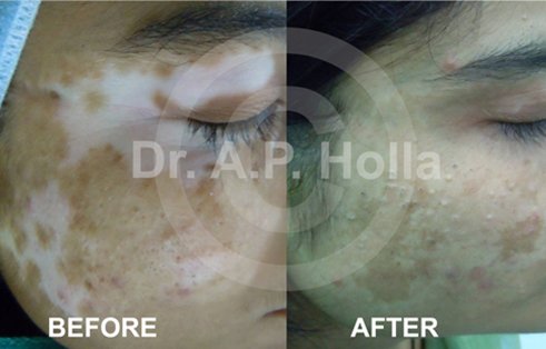 face vitiligo treatment delhi