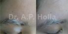 treatment for vitiligo around   eyes