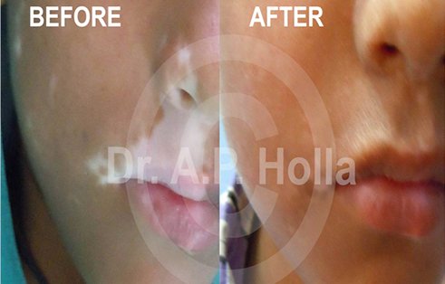 upper lips vitiligo treatment   newdelhi