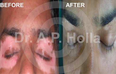 vitiligo around eye treatment   delhi