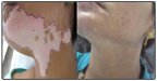 vitiligo-treatment delhi