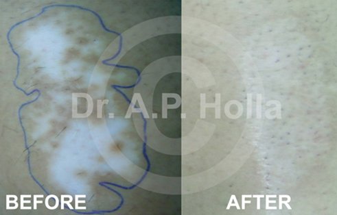 vitiligo treatment delhi